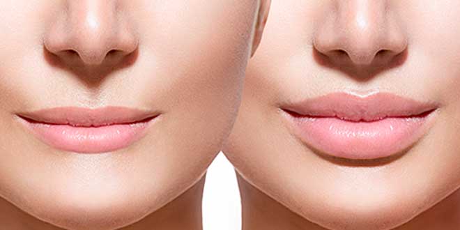 acido-hialuronico-labis