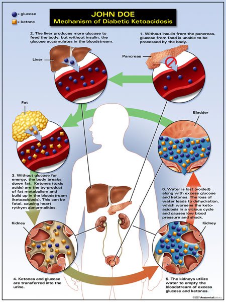ketoacidosis
