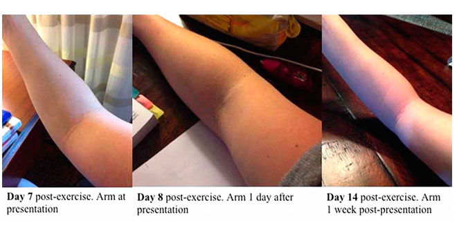 edema edema