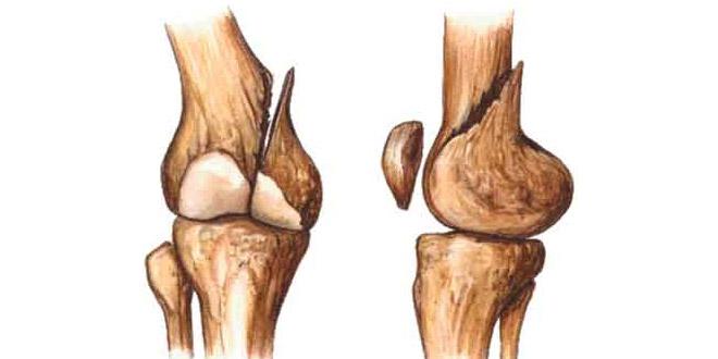 Alimentos para a cura de ossos fraturados