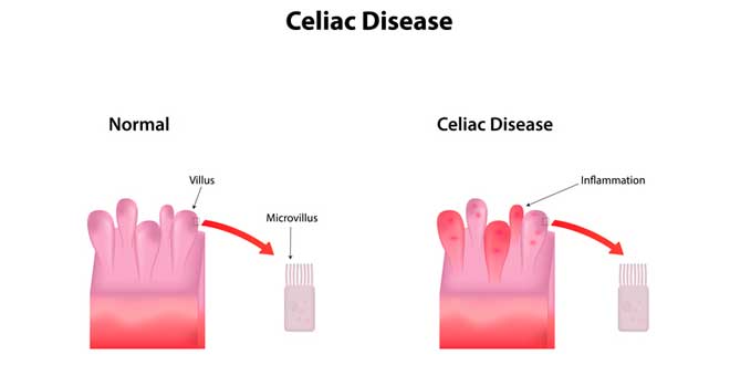 celíaca celíaca