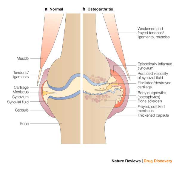 cartilagem osteoartrite