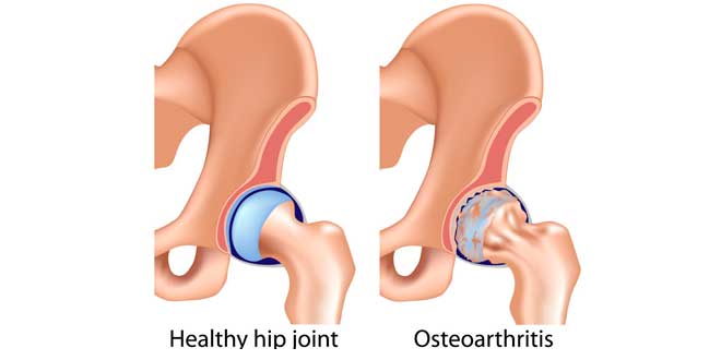sintomas osteoatrite sintomas osteoatrite