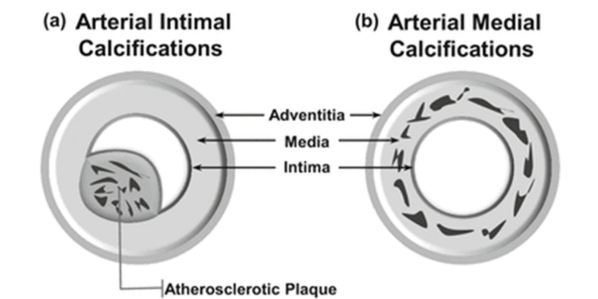 Calcificação vascular