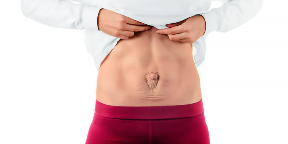 Diastasis abdominal femenina