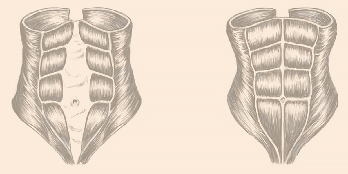 Separação abdominal