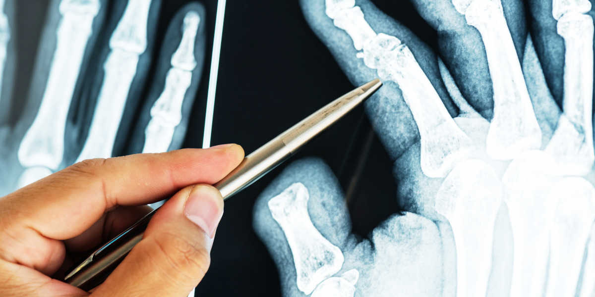 Osteoporosis vitamina D