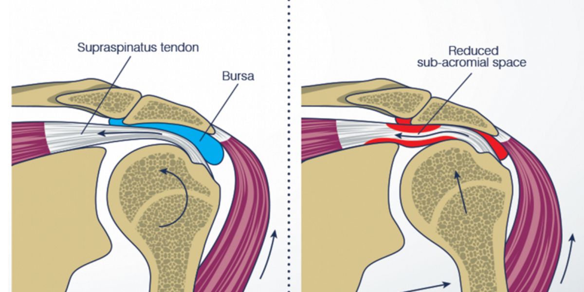 Tendinite e Bursite Tendinite e Bursite