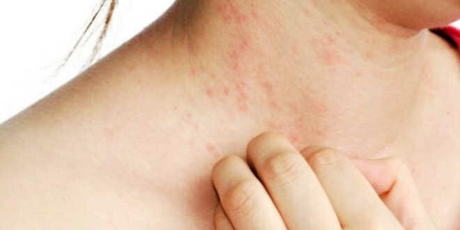 Dermatite – Causas, tipos e como tratar este problema de pele