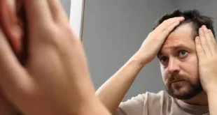 Como tratar a alopecia e evitar a queda de cabelo