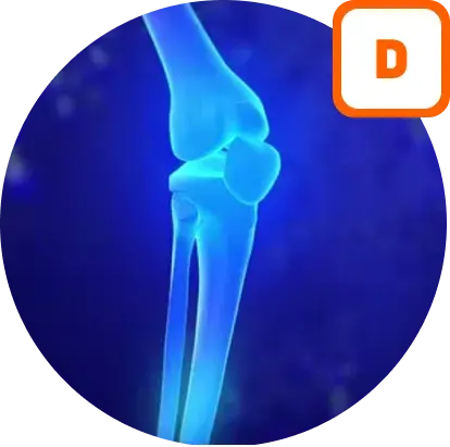 Influ&ecirc;ncia da Vitamina D no desenvolvimento &oacute;sseo